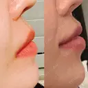 人中短縮 / 口唇縮小術 / 口角挙上 HB整形外科 DAY 120 サムネイル用