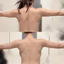 脂肪吸引（二の腕） / 脂肪吸引（お腹） / 豊胸（脂肪注入） / 脂肪吸引（背中） / 脂肪吸引（肩） / 脂肪注入（お尻） ICON CLINIC DAY 24 サムネイル用