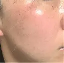 ルメッカ 仙台TAクリニック DAY 3 サムネイル用