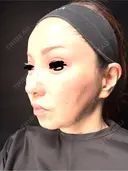 タレ目形成・グラマラスライン（埋没） Zetith Beauty Clinic 銀座院 AFTER サムネイル用