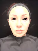 タレ目形成・グラマラスライン（埋没） Zetith Beauty Clinic 銀座院 DAY 9 サムネイル用