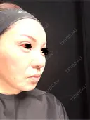 タレ目形成・グラマラスライン（埋没） Zetith Beauty Clinic 銀座院 DAY 9 サムネイル用