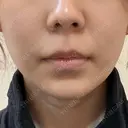 糸リフト / 脂肪吸引（顔） / 脂肪注入（額） / メーラーファット除去 / ジョールファット除去 First Clinic AFTER サムネイル用