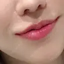 人中短縮 / 口唇縮小術 / 口角挙上 HB整形外科 DAY 120 サムネイル用