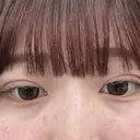 二重埋没 アリエル美容クリニック 郡山院 DAY 5 サムネイル用