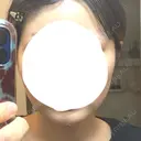 インモード 小倉美容外科/美容皮膚科 ビラビューティークリニック AFTER サムネイル用