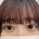 二重埋没 アリエル美容クリニック 郡山院 DAY 6 サムネイル用