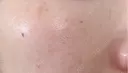 ピーリング（ニキビ・毛穴） / ルメッカ ルラ美容クリニック 大宮院 / ルラスキンクリニック 大宮院 DAY 1 サムネイル用