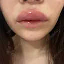 ヒアルロン酸注入（涙袋） / ヒアルロン酸注入（唇） PRO CLINIC プロクリニック 銀座院 DAY 1 サムネイル用