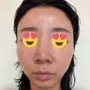 糸リフト / 脂肪吸引（顔） EMMA CLINIC（エマクリニック） AFTER サムネイル用