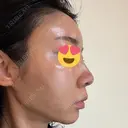 糸リフト / 脂肪吸引（顔） EMMA CLINIC（エマクリニック） DAY 90 サムネイル用