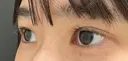二重埋没 eクリニック 那覇院 DAY 27 サムネイル用