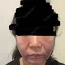 糸リフト / バッカルファット除去 / 脂肪吸引（顔） / ジョールファット除去 / ボトックス（エラ・小顔） Lipo Clinic omotesando AFTER サムネイル用