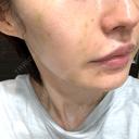 肌育注射（ジュベルックなど） ハナビューティークリニック DAY 3 サムネイル用