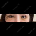 クマ治療 / 目尻切開 / タレ目形成・グラマラスライン（切開） / 脂肪注入（目の下） 藤・ナチュレ美容クリニック 銀座院 DAY 3 サムネイル用