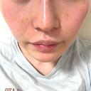 肌育注射（ジュベルックなど） ハナビューティークリニック DAY 4 サムネイル用
