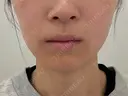 ボトックス（エラ・小顔） PRO CLINIC プロクリニック 銀座院 AFTER サムネイル用