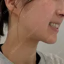 ボトックス（エラ・小顔） PRO CLINIC プロクリニック 銀座院 DAY 0 サムネイル用