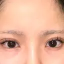 二重埋没 恵聖会クリニック 京橋院 DAY 8 サムネイル用