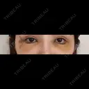 クマ治療 / 目尻切開 / タレ目形成・グラマラスライン（切開） / 脂肪注入（目の下） 藤・ナチュレ美容クリニック 銀座院 DAY 4 サムネイル用