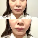 ハイフ（顔） 城本クリニック 立川院 AFTER サムネイル用