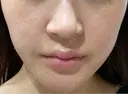 シミ取りレーザー / LDM・インテンスウルトラ Wi Clinic （ウィ クリニック）心斎橋院 AFTER サムネイル用