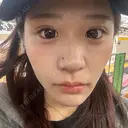 二重埋没 / ほくろ・いぼ切除（肌） / 上まぶたの脂肪取り / タレ目形成・グラマラスライン（切開） / 目元修正 / ボトックス（眉間） 藤・ナチュレ美容クリニック 銀座院 DAY 15 サムネイル用
