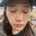 二重埋没 / ほくろ・いぼ切除（肌） / 上まぶたの脂肪取り / タレ目形成・グラマラスライン（切開） / 目元修正 / ボトックス（眉間） 藤・ナチュレ美容クリニック 銀座院 DAY 15 サムネイル用