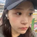 二重埋没 / ほくろ・いぼ切除（肌） / 上まぶたの脂肪取り / タレ目形成・グラマラスライン（切開） / 目元修正 / ボトックス（眉間） 藤・ナチュレ美容クリニック 銀座院 DAY 15 サムネイル用