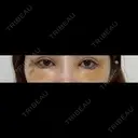クマ治療 / 目尻切開 / タレ目形成・グラマラスライン（切開） / 脂肪注入（目の下） 藤・ナチュレ美容クリニック 銀座院 DAY 5 サムネイル用