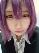 糸リフト / 脂肪吸引注射（顔） EMMO FACE CLINIC 大阪梅田院 DAY 305 サムネイル用