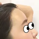 額を丸く エートップ美容整形外科 DAY 1 サムネイル用