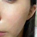 LDM・インテンスウルトラ Ledian Clinic六本木 DAY 6 サムネイル用