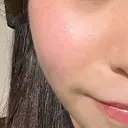 LDM・インテンスウルトラ Ledian Clinic六本木 AFTER サムネイル用