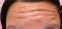 ボトックス（額） 神戸スイミー皮膚科美容外科 DAY 0 サムネイル用