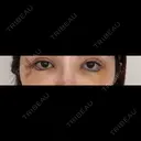 クマ治療 / 目尻切開 / タレ目形成・グラマラスライン（切開） / 脂肪注入（目の下） 藤・ナチュレ美容クリニック 銀座院 DAY 6 サムネイル用