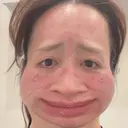 ダーマペン L‘amour clinic Tokyo【ラムールクリニック東京】 AFTER サムネイル用