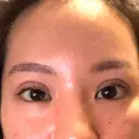 二重埋没 / ヒアルロン酸注入（唇） / ボトックス（口角） ルラ美容クリニック 名古屋栄院 / ルラスキンクリニック 名古屋栄院 AFTER サムネイル用