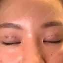 二重埋没 / ヒアルロン酸注入（唇） / ボトックス（口角） ルラ美容クリニック 名古屋栄院 / ルラスキンクリニック 名古屋栄院 DAY 0 サムネイル用