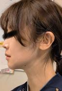 骨切り（あご） / 骨削り（エラ） / 骨削り（頬） セギム美容整形外科 AFTER サムネイル用
