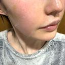 肌育注射（ジュベルックなど） ハナビューティークリニック DAY 7 サムネイル用