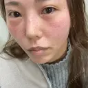 マイクロボトックス / リジュラン 城本クリニック 新宿院 DAY 0 サムネイル用