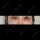 クマ治療 / 目尻切開 / タレ目形成・グラマラスライン（切開） / 脂肪注入（目の下） 藤・ナチュレ美容クリニック 銀座院 DAY 7 サムネイル用