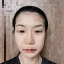 ボトックス（エラ・小顔） 品川美容外科 仙台院 AFTER サムネイル用