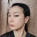 ボトックス（エラ・小顔） 品川美容外科 仙台院 DAY 3 サムネイル用