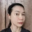 ボトックス（エラ・小顔） 品川美容外科 仙台院 DAY 3 サムネイル用