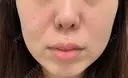 デンシティ フィラークリニック 新宿院 AFTER サムネイル用