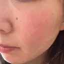 ルメッカ ルラ美容クリニック 名古屋栄院 / ルラスキンクリニック 名古屋栄院 DAY 1 サムネイル用