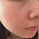 ルメッカ ルラ美容クリニック 名古屋栄院 / ルラスキンクリニック 名古屋栄院 DAY 1 サムネイル用