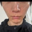 デンシティ 湘南美容クリニック 豊田院 DAY 4 サムネイル用